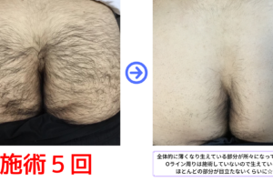 メンズのお尻脱毛で後ろ姿も完璧に！見た目と快適さを手に入れる方法【RASHINDO大和店】
